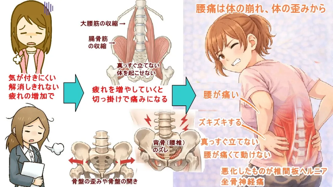 大腰筋、腸骨筋の収縮で痛みが
